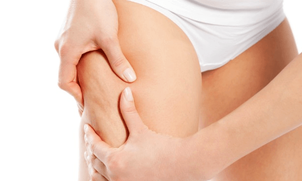 cellulite