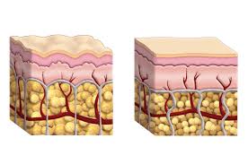 cellulite